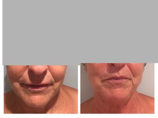 Antes y después rejuvenecimiento facial