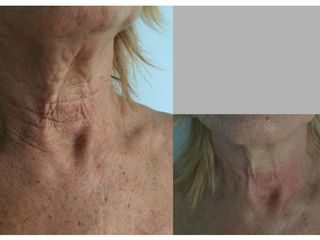 Antes y después tratamiento de cuello