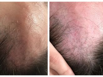 Alopecia - 629161