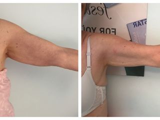 Antes y después tratamiento brazos 