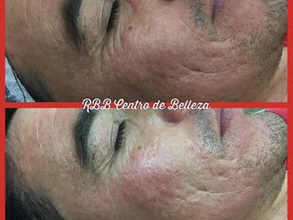 Eliminación ojeras - 642695