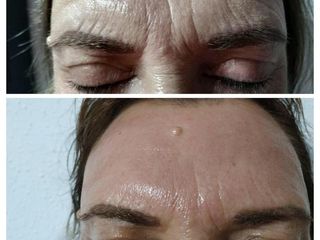 Antes y después eliminación arrugas 