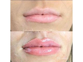Antes y después Aumento de labios