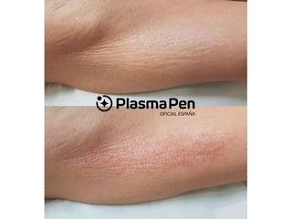 Eliminación de estrías con Plasma Pen - Balneo Estetic Pasbel