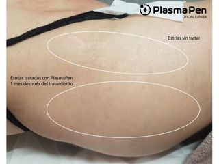 Eliminación de estrías con Plasma Pen - Balneo Estetic Pasbel
