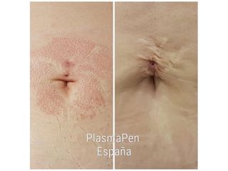 Eliminación de cicatrices con Plasma Pen - Balneo Estetic Pasbel