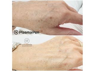 Eliminación de manchas con Plasma Pen - Balneo Estetic Pasbel