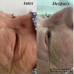 Eliminación de arrugas con Plasma Pen - Balneo Estetic Pasbel