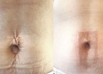 Eliminación de cicatrices con Plasma Pen - Balneo Estetic Pasbel