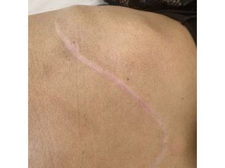Cicatriz - Balneo Estetic Pasbel