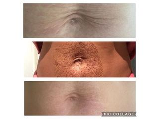 Tratamiento flacidez abdominal - Balneo Estetic Pasbel