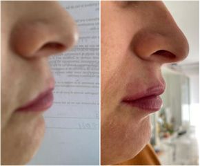Aumento de labios - Balneo Estetic Pasbel