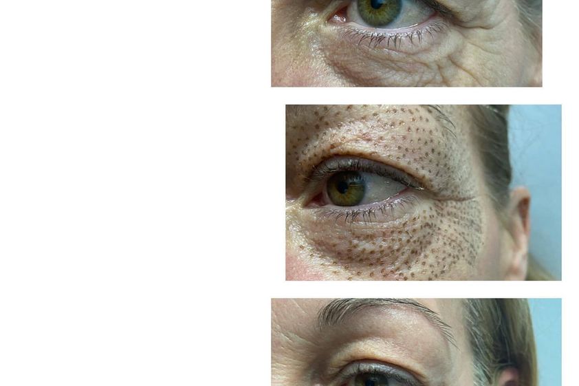 Blefaroplastia sin cirugía antes y después - 846113