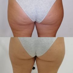 Ondas de choque EMS - Balneo Estetic Pasbel