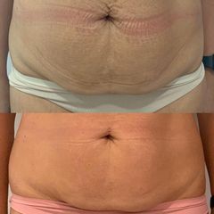 Ondas de choque EMS - Balneo Estetic Pasbel