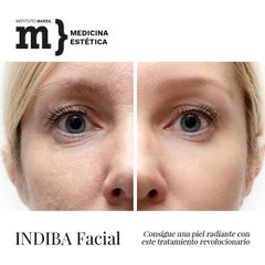 Rejuvenecimiento facial - Instituto Marsil
