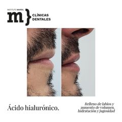 Aumento de labios - Instituto Marsil
