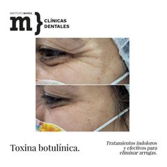 Toxina Botulínica - Instituto Marsil