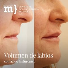 Aumento de labios - Instituto Marsil