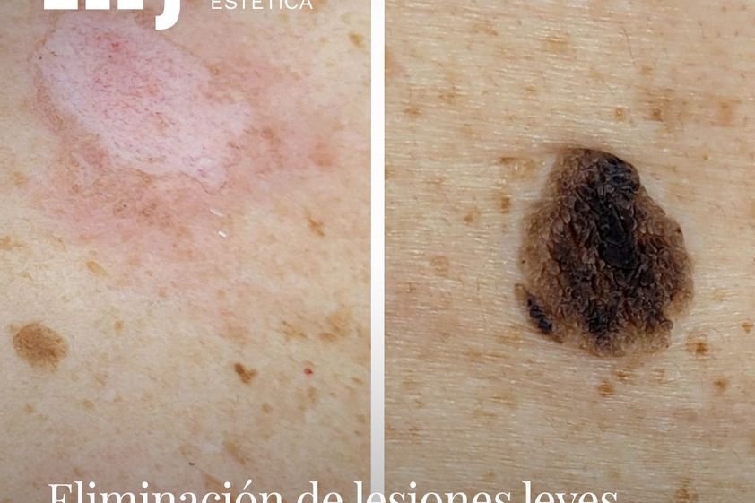 Lunares antes y después - 851543