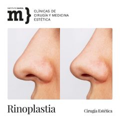 Rinoplastia - Instituto Marsil