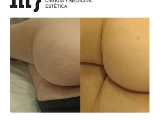 Eliminación de estrías antes y después - 858764