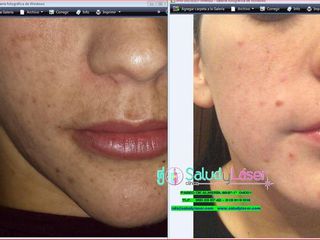 Antes y después Tratamiento acné