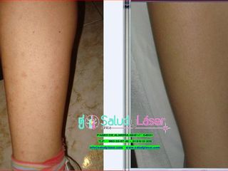 blanqueamiento piel piernas