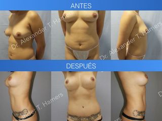 Antes y después Mommy Makeover 