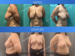 Antes y después Reducción Mamaria 