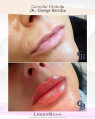 Aumento de labios - Clínica Lasernova- labios rusos