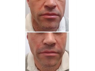 Rellenos faciales arrugas hombres  - Clínica Lasernova