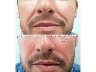 Rellenos faciales hombres - Clínica Lasernova