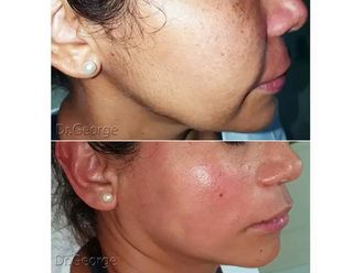 Marcación mandibular antes y después - 856992