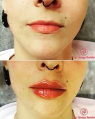 Aumento labios - Clínica Lasernova