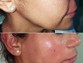Marcación mandibular antes y después - 860862