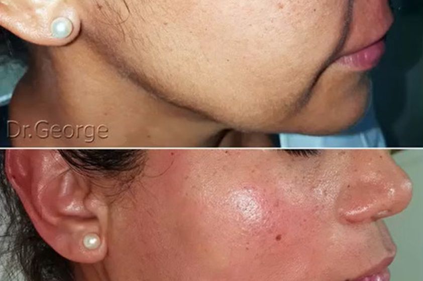 Marcación mandibular antes y después - 860862