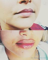 Aumento de labios - Clínica Lasernova