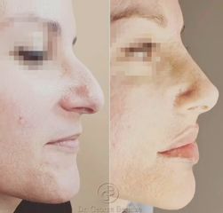Rinomodelación - Clínica Lasernova- rinoplastia