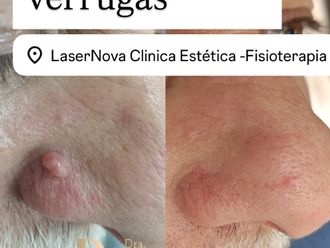 Verrugas antes y después - 878636