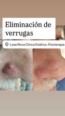 eliminación verrugas -lunares láser