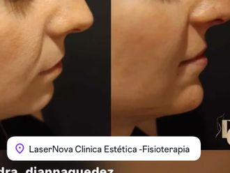 Rinomodelación antes y después - 878637