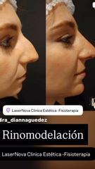 Rinomodelación , antes y después .Lasernova