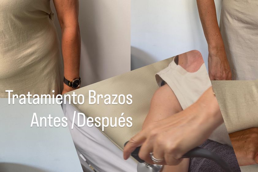 Eliminar grasa localizada antes y después - 878638