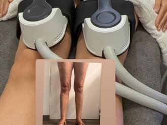 Lipedema antes y después - 878639