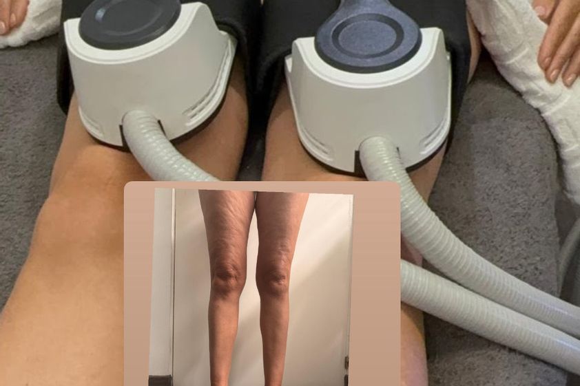 Lipedema antes y después - 878639