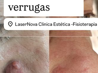 Verrugas antes y después - 878640