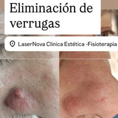 Eliminación de verrugas y lunares con láser