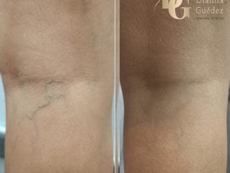 Tratamiento varices antes y después - 878641