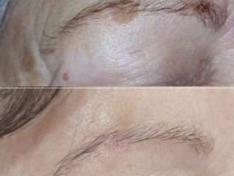 Tratamiento antimanchas antes y después - 878643